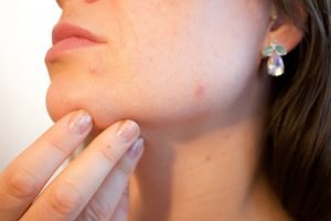 Tips to Get Rid of Blemishes Forever