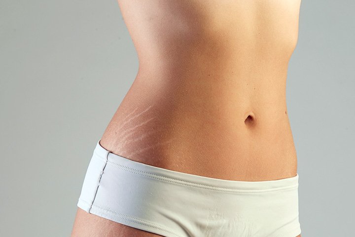 12 Best Stretch Mark Removal Cream Reviews-How To Get Rid of