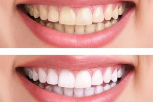 How To Use Teeth Whitening Toothpaste Properly