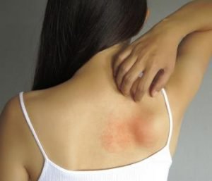 Eczema for Effective Treatment